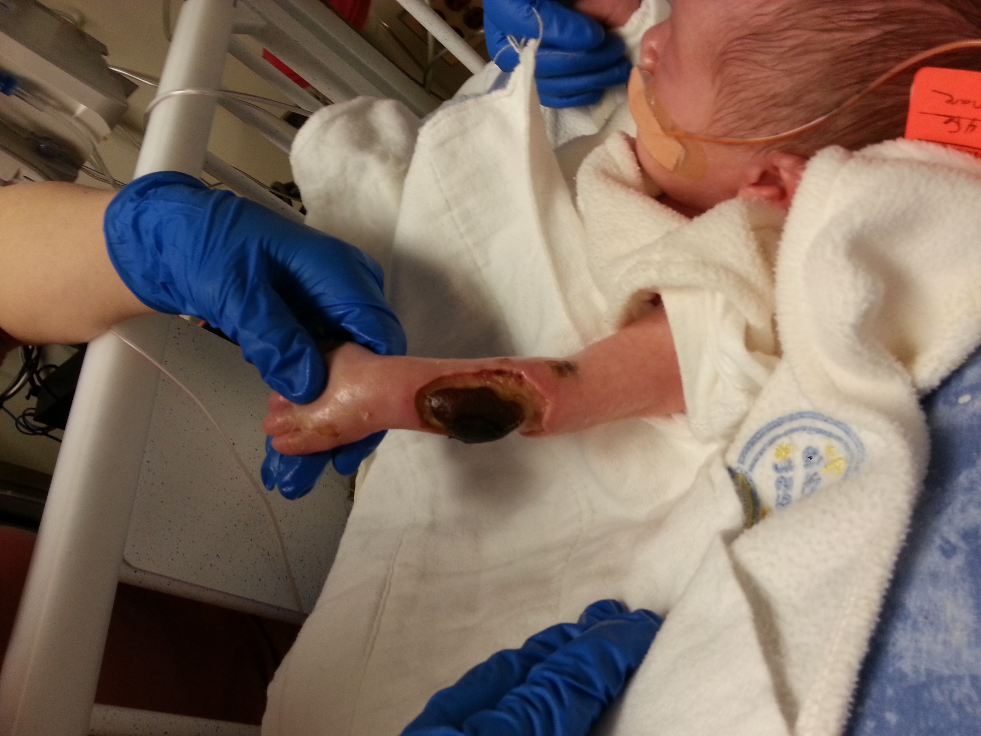 One of Connor's many wound dressing changes
