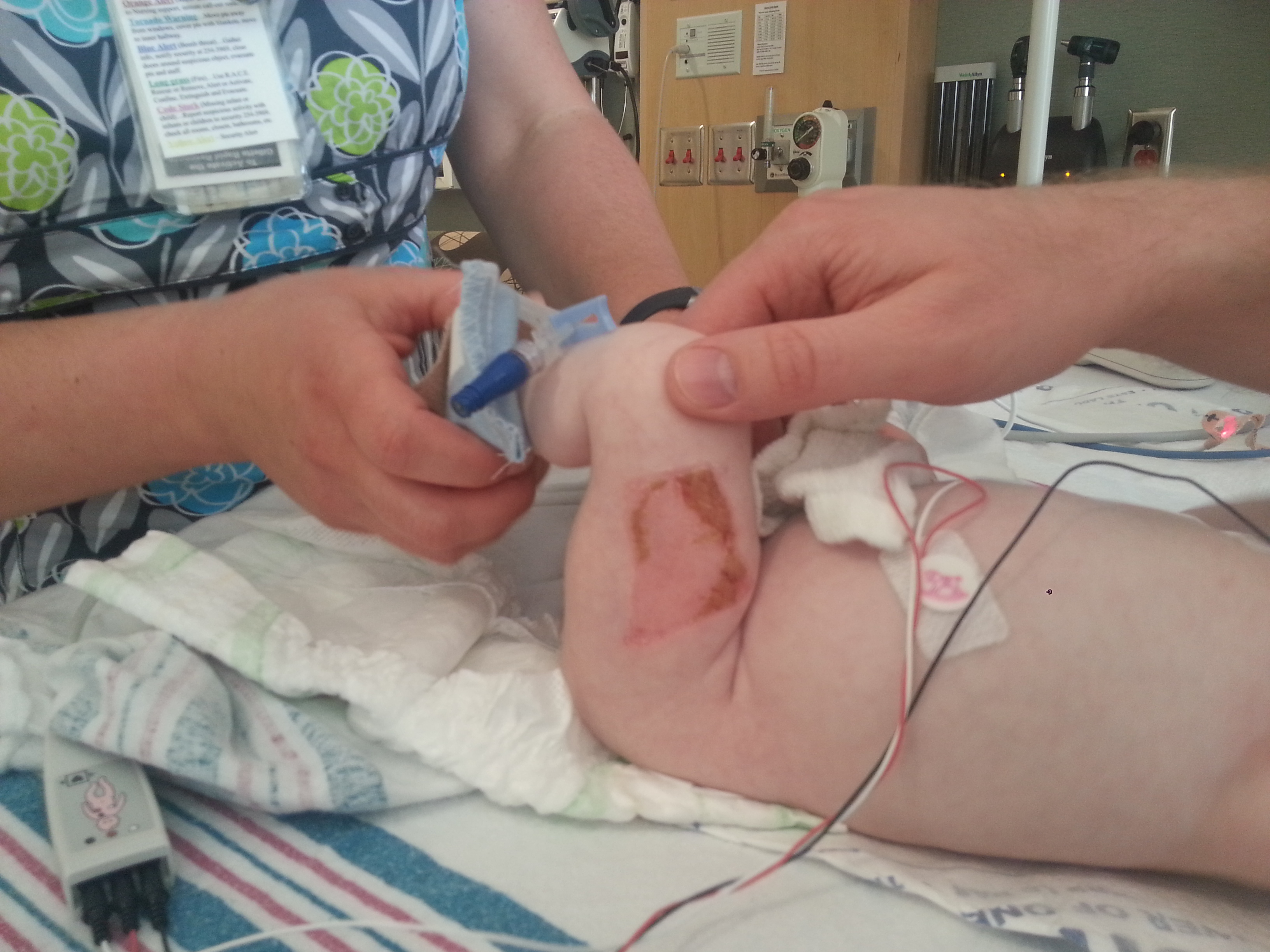 Connor's Skin Graft Donor Site