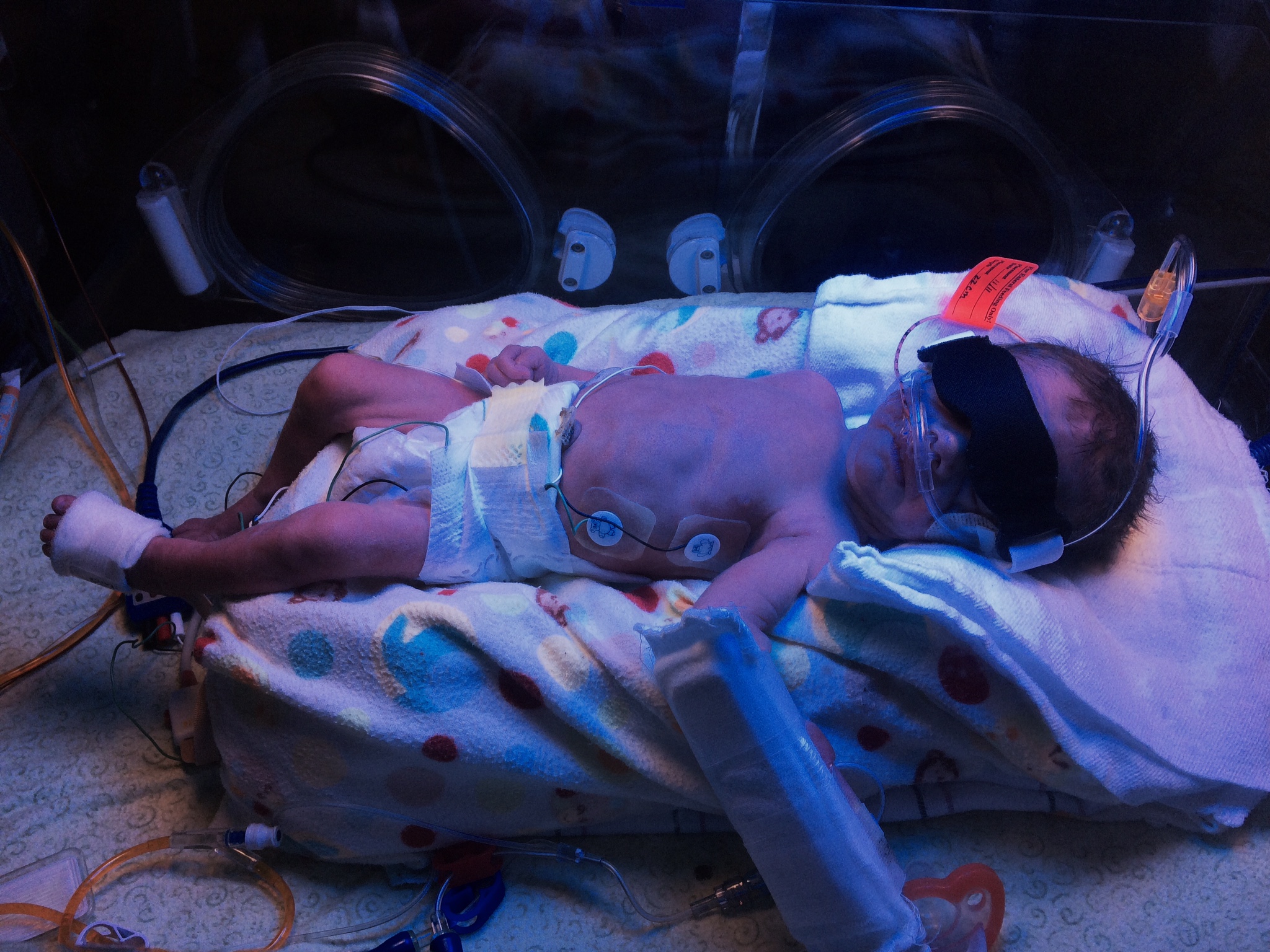 Max under the bili-lights just days old