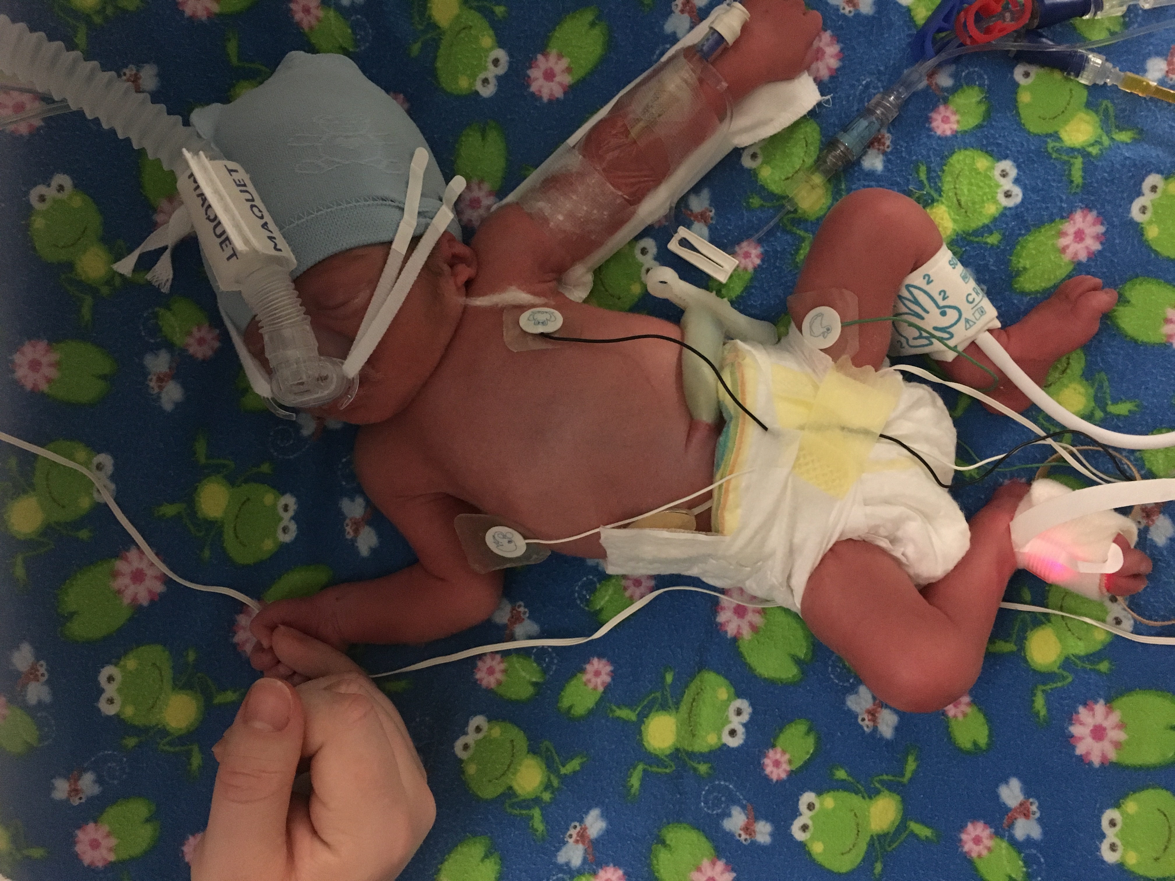 February 2016 - Just Born, First Time I Saw/Touched Dylan in the NICU