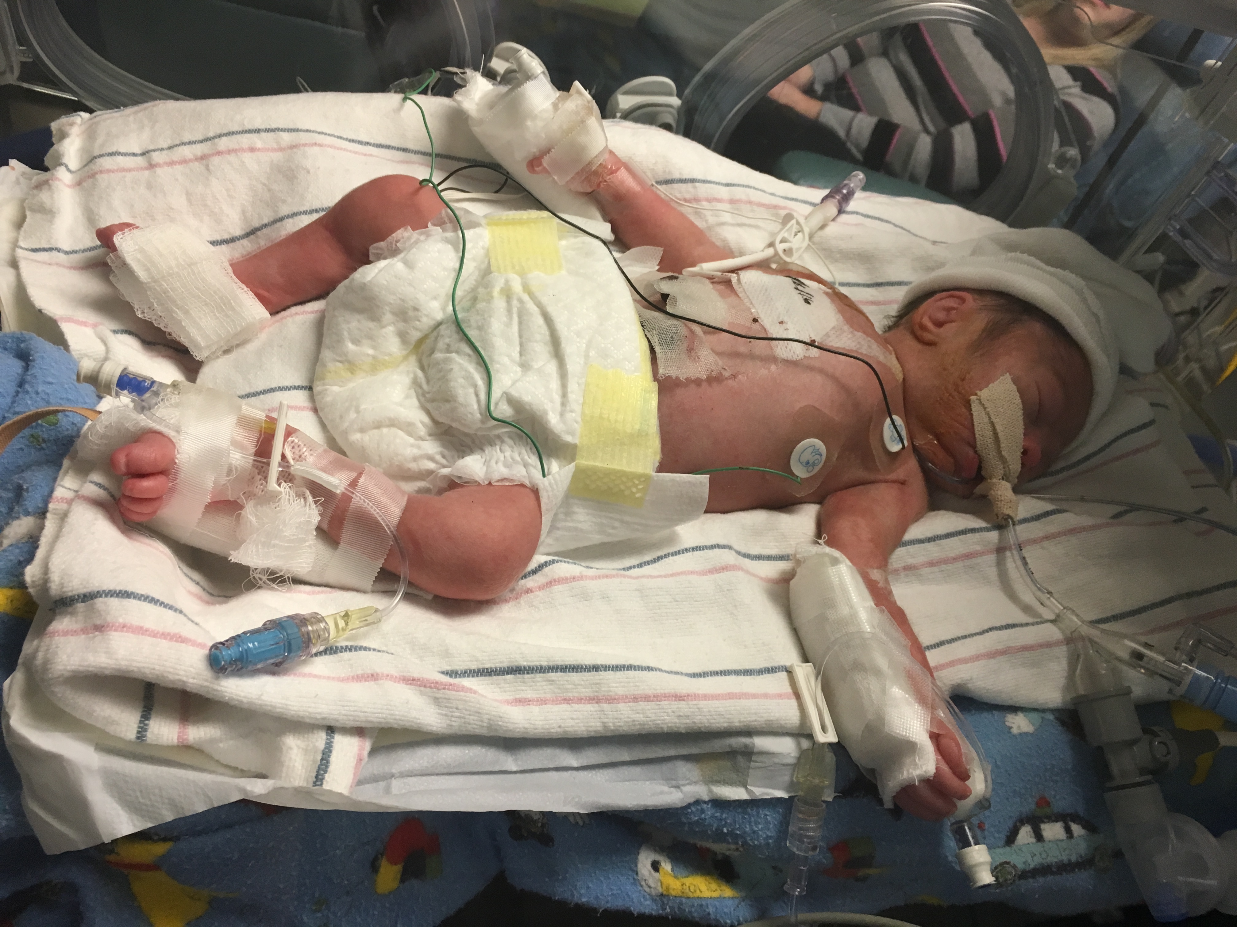 February 2016 - 4 Days Old, After 1st Surgery